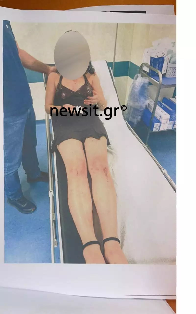 Τρέμει για τη ζωή της η 19χρονη που ξυλοκοπήθηκε άγρια από τον 23χρονο σύντροφό της στη Χαλκίδα - «Είναι ακόμα ελεύθερος, φοβάμαι»