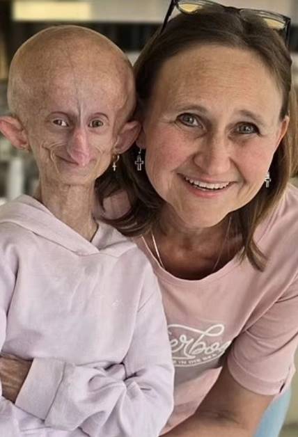 Beandri Booysen: Έφυγε από τη ζωή η 19χρονη κοπέλα που έπασχε από πρόωρη γήρανση – Συγκλονίζει η ζωή της 2 Beandri Booysen: Έφυγε από τη ζωή η 19χρονη κοπέλα που έπασχε από πρόωρη γήρανση – Συγκλονίζει η ζωή της