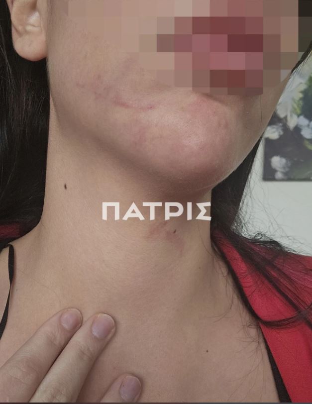 Πήγαν για τριήμερη εκδρομή στην Έδεσσα και την έστειλε στο νοσοκομείο με κατάγματα πλευρών και χτυπήματα 11 Πήγαν για τριήμερη εκδρομή στην Έδεσσα και την έστειλε στο νοσοκομείο με κατάγματα πλευρών και χτυπήματα