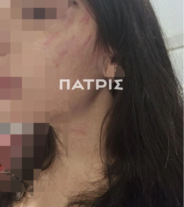 Πήγαν για τριήμερη εκδρομή στην Έδεσσα και την έστειλε στο νοσοκομείο με κατάγματα πλευρών και χτυπήματα 12 Πήγαν για τριήμερη εκδρομή στην Έδεσσα και την έστειλε στο νοσοκομείο με κατάγματα πλευρών και χτυπήματα