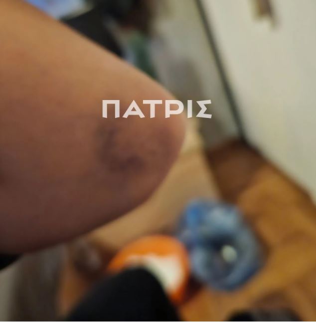 Πήγαν για τριήμερη εκδρομή στην Έδεσσα και την έστειλε στο νοσοκομείο με κατάγματα πλευρών και χτυπήματα 14 Πήγαν για τριήμερη εκδρομή στην Έδεσσα και την έστειλε στο νοσοκομείο με κατάγματα πλευρών και χτυπήματα