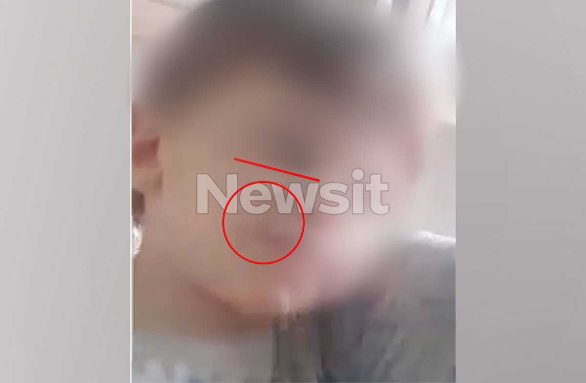 Ηράκλειο: Ανέβαζε βίντεο στο Tiktok με τα σημάδια κακοποίησης στο προσωπάκι του τρίχρονου Άγγελου