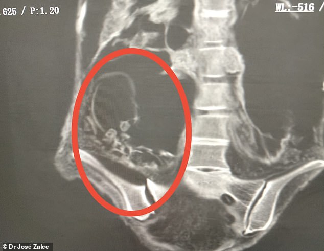 Περού: Επιβεβαίωθηκε η αυθεντικότητα των «εξωγήινων μουμιών» με τα τρία δάχτυλα από τη Νάζκα 4 The researchers conducted a recent scan of a mummy named 'Montserrat,' finding it was pregnant at the time of death, which they believe was at least 1,200 years ago