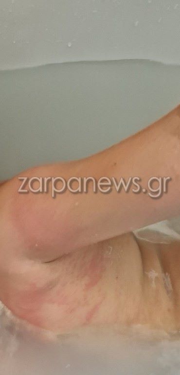 Χανιά: 11χρονος δέχθηκε επίθεση από θαλάσσια ανεμώνη και καλύφθηκε με εξανθήματα 3 Τσίμπημα από θαλάσσια ανεμώνη