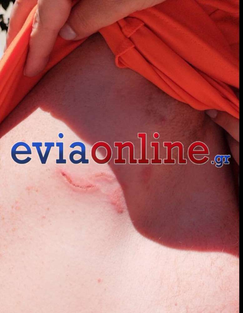 πληγή από τσίμπημα μωβ μέδουσας