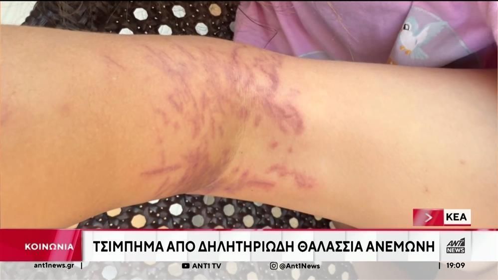 Τσίμπημα-απο-θαλάσσια-ανεμώνη-Στην-Αθήνα-μεταφέρθηκε-εξάχρονη