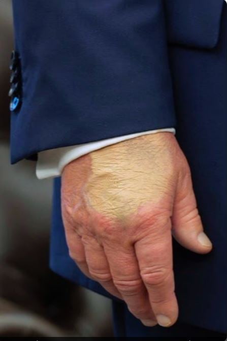 Τραμπ: Καταιγισμός εικασιών για την υγεία του Αμερικανού προέδρου – Φωτογραφίες με μελανιές στα χέρια, πρησμένους αστραγάλους και στραβά γόνατα