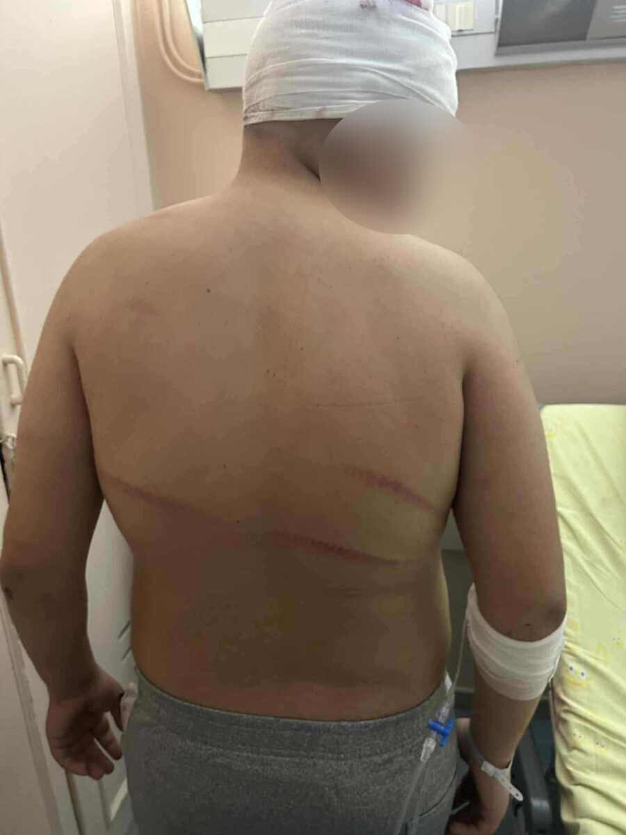 Θεσσαλονίκη: Συγκλονίζει ο πατέρας του 13χρονου θύματος ξυλοδαρμού – «Έχει τρύπες 15 πόντων στο κεφάλι»