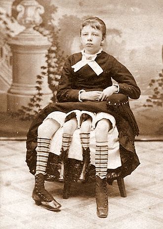 Josephine Myrtle Bicknell: Το κορίτσι με τα τέσσερα πόδια από το Τέξας που ενταφιάστηκε σε τσιμέντο 2 Josephine Myrtle Bicknell: Το κορίτσι με τα τέσσερα πόδια από το Τέξας που ενταφιάστηκε σε τσιμέντο