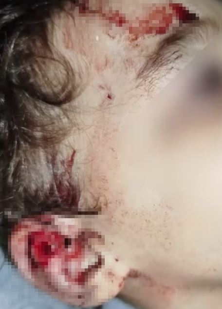 Γιγαντιαίος αρουραίος επιτέθηκε σε 2χρονο αγόρι: Του δάγκωσε το αυτί μέσα στο σπίτι του