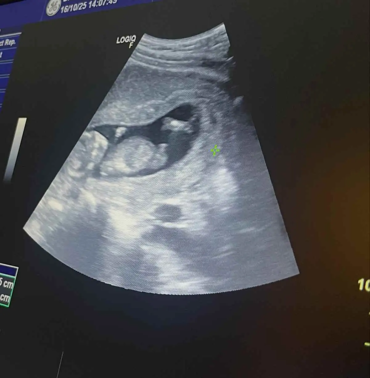 Τριγωνίδου: Μοιράστηκε εικόνες από το υπερηχογράφημα του μωρού της – «Η πιο σημαντική στιγμή της ζωής μου» 5 Το υπερηχογράφημα της Πωλίνας Τριγωνίδου