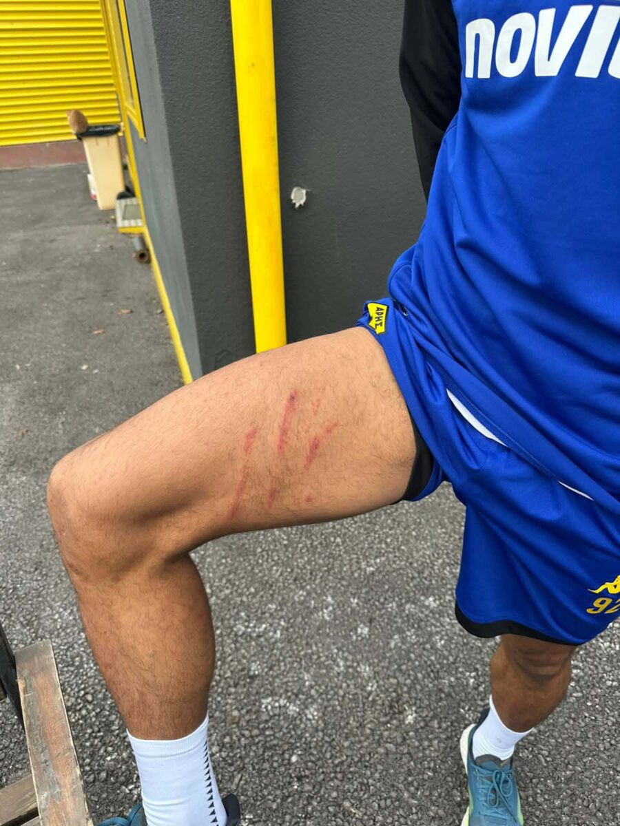 Άρης: Τα ίχνη που άφησε στο πόδι του Ρόουζ το τάκλιν του Ιβανούσετς 2 Άρης: Τα ίχνη που άφησε στο πόδι του Ρόουζ το τάκλιν του Ιβανούσετς