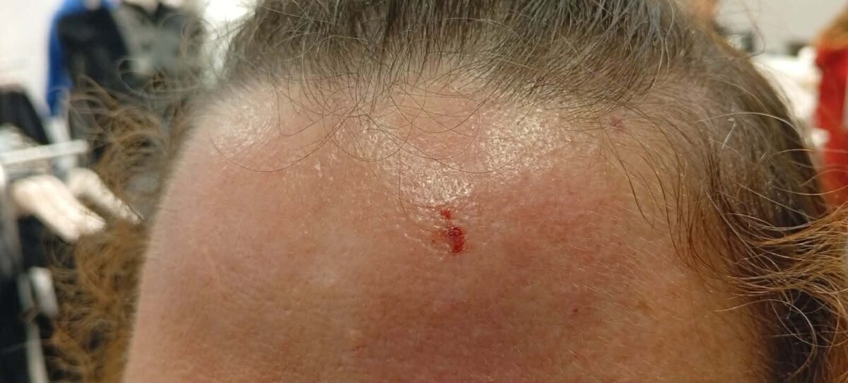 Τραυματισμός από πυροτέχνημα