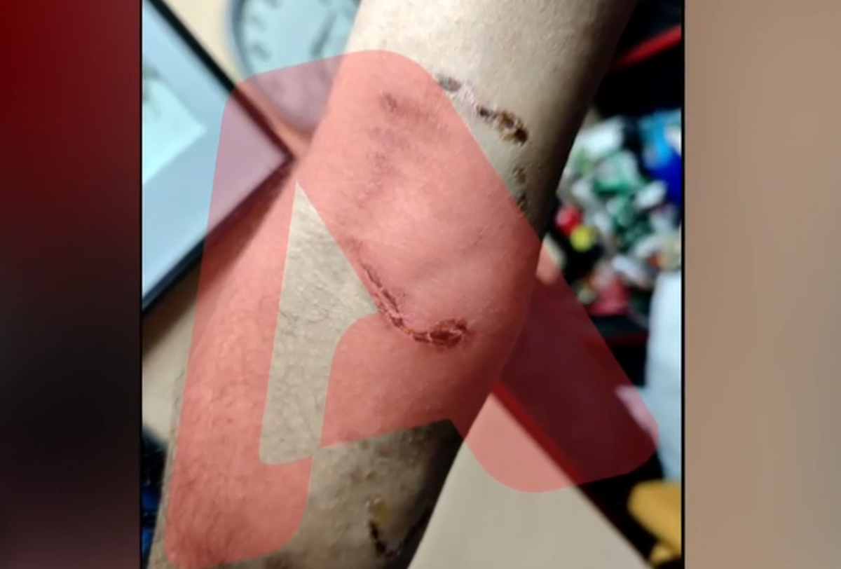 Ομόνοια: Νεαρός χρησιμοποίησε το πίτμπουλ του για επίθεση σε 30χρονο με σκοπό τη ληστεία – «Με έριξε κάτω και το σκυλί με δάγκωνε»