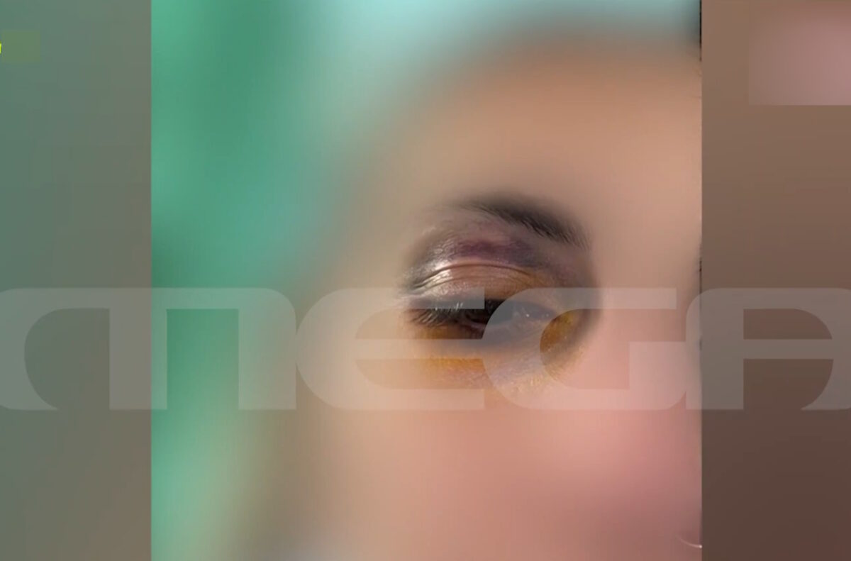 Βίαιος ξυλοδαρμός 25χρονης από τον σύντροφό της: Την έσυρε από τα μαλλιά και της μαύρισε το μάτι – «Δεν με άφηνε να φύγω»