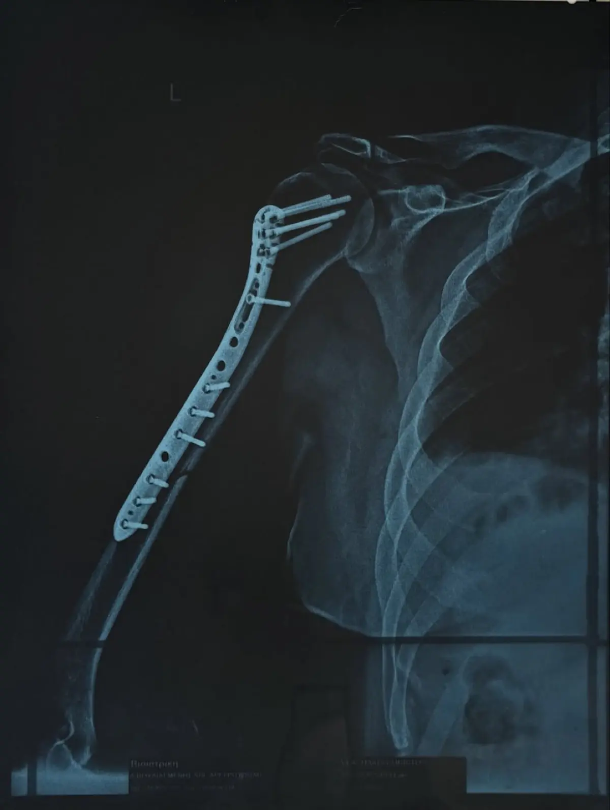 Χρήστος Δάντης: Η πρώτη δημοσίευση μετά την επέμβαση – «Το χέρι μου ήταν κατεστραμμένο» 5 Χρήστος Δάντης χέρι