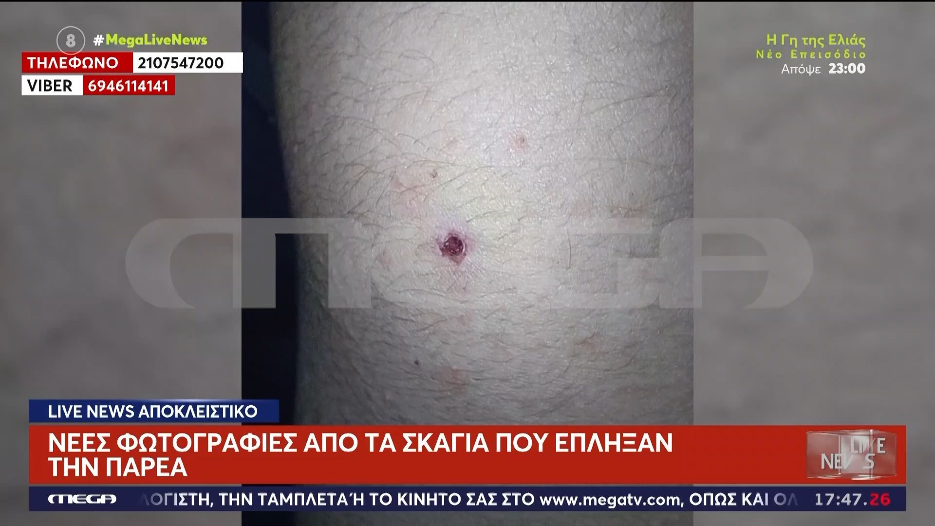 Αίγιο: Νέες φωτογραφίες από τα σκάγια που έπληξαν την παρέα – «Κυνηγός είναι, είδε το θήραμά του» λέει πατέρας θύματος