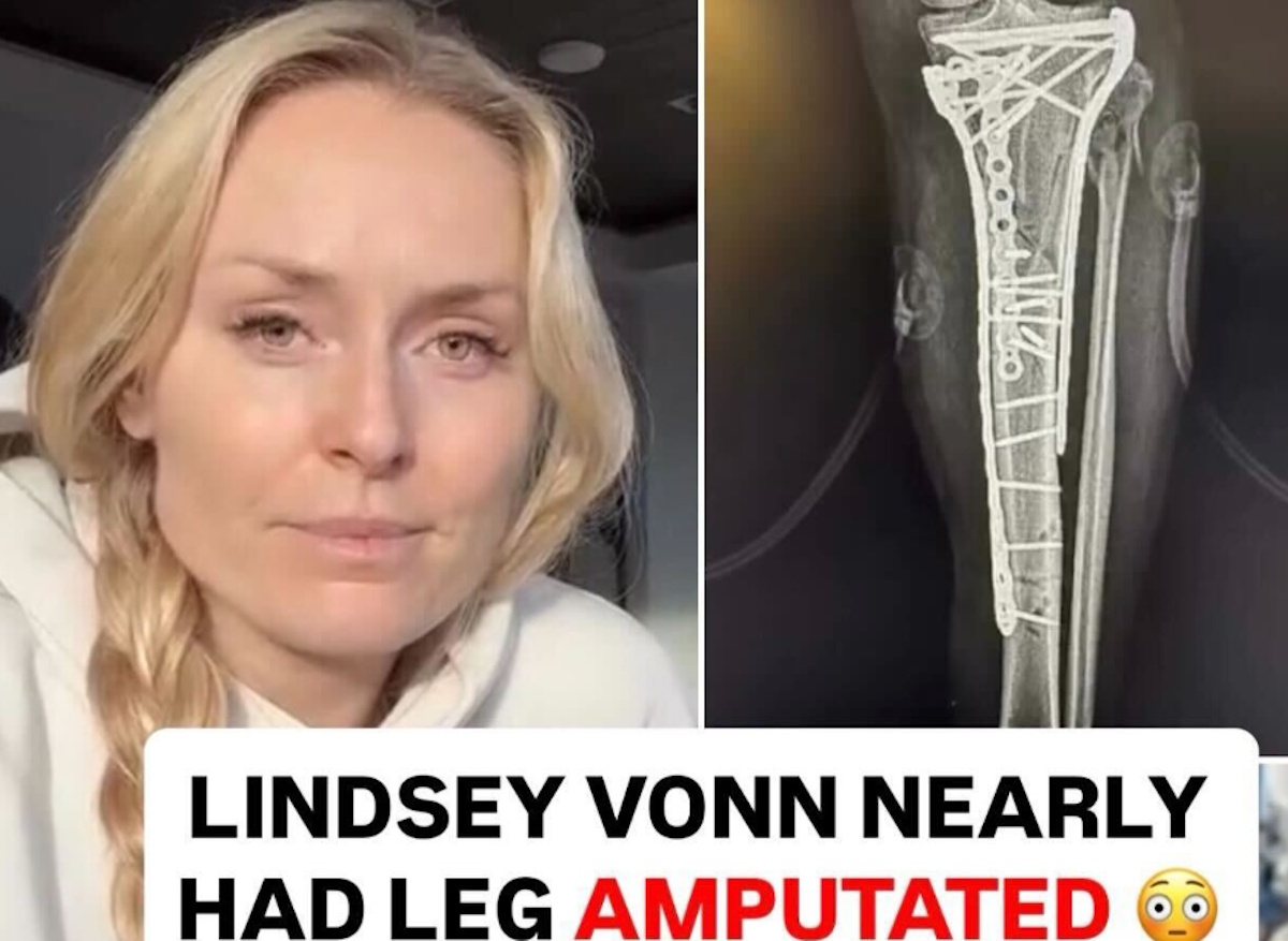 Λίντσεϊ Βον: «Η εγχείρηση μετά το ατύχημα με έσωσε από ακρωτηριασμό»