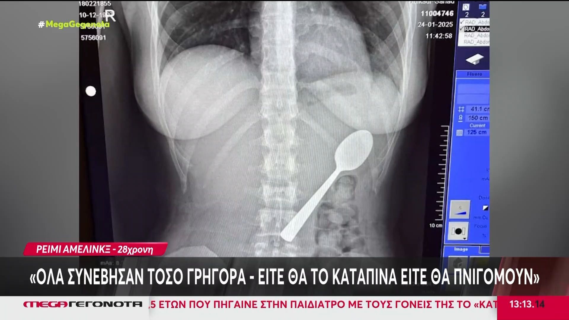 Βέλγιο: 28χρονη κατάπιε κατά λάθος κουτάλι 17 εκατοστών