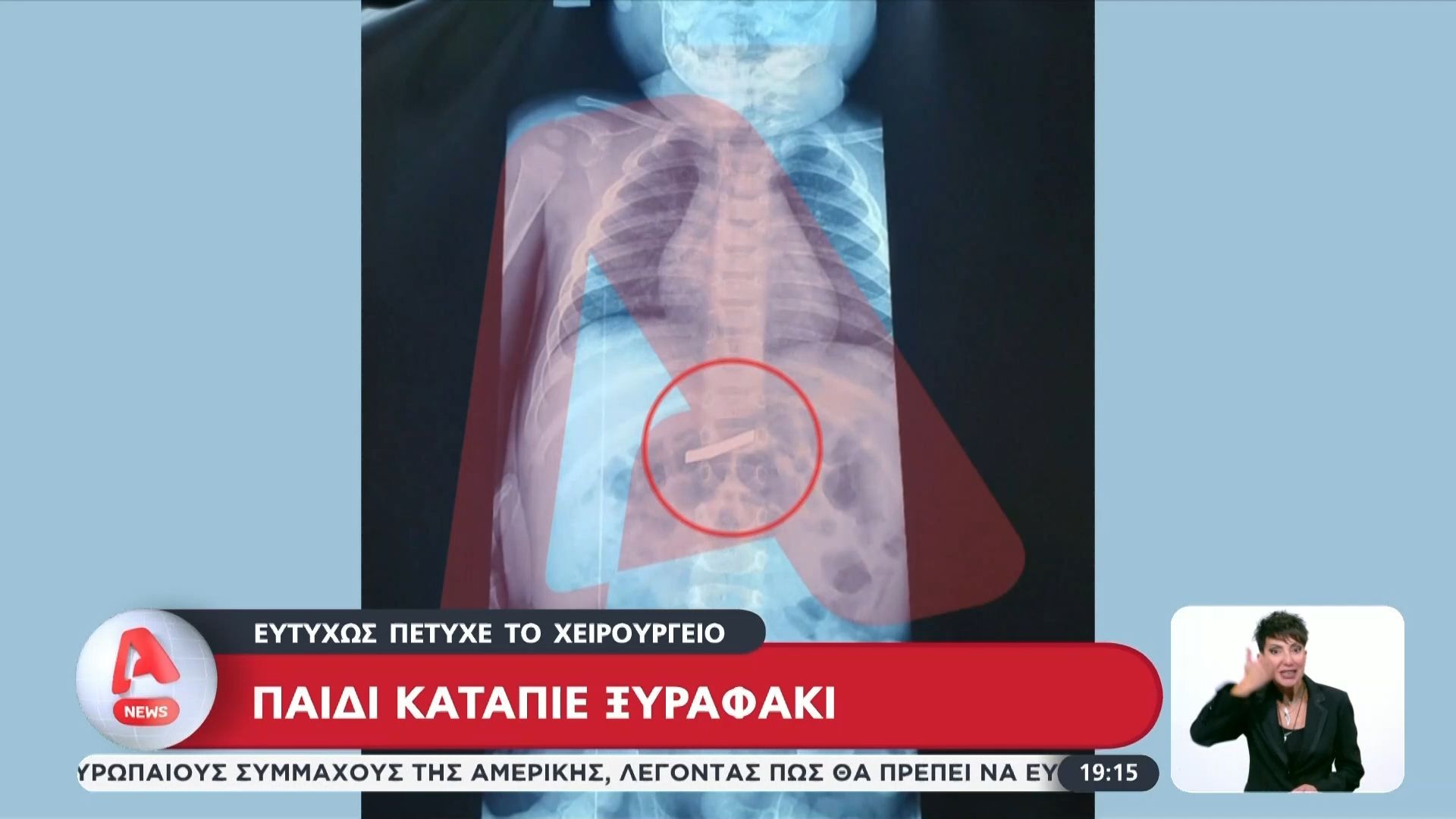 Επιτυχημένο το χειρουργείο για το ανήλικο που κατάπιε ξυραφάκι