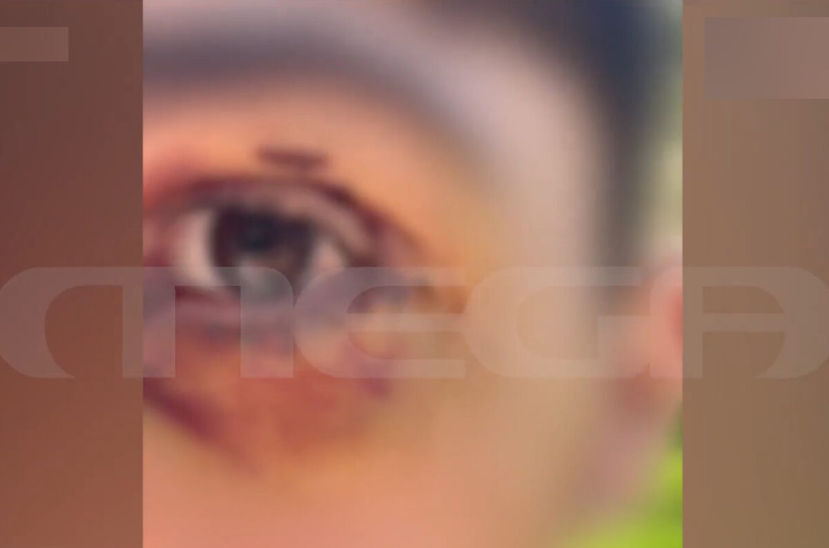 Ιωάννινα: Βίαιος ξυλοδαρμός 16χρονου από συνομηλίκους – «Πήγε βόλτα και παραλίγο να χάσει την όρασή του» αναφέρει η μητέρα του