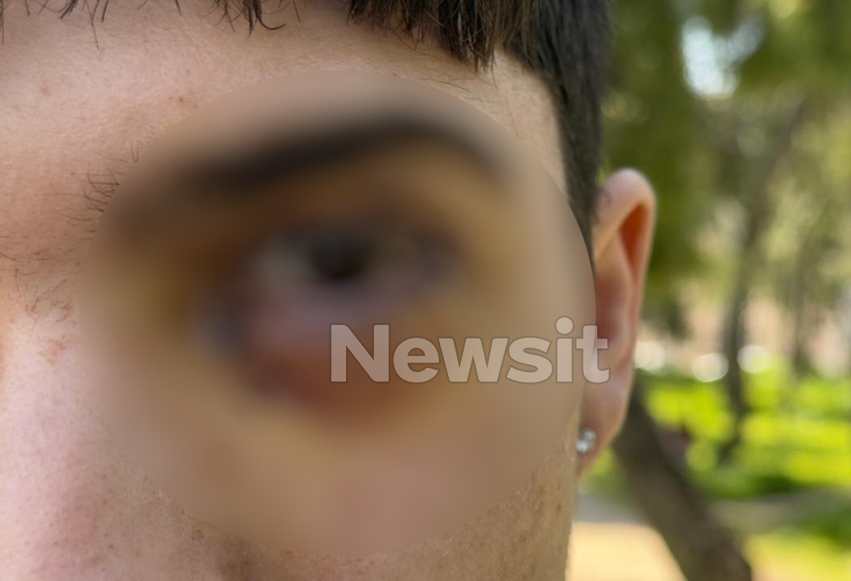 Επίθεση σε ανήλικο στα Ιωάννινα: 17 ράμματα στο μάτι υπέστη ο 16χρονος – «Τον χτύπησαν με μανία, έχει υποστεί ζημιά»
