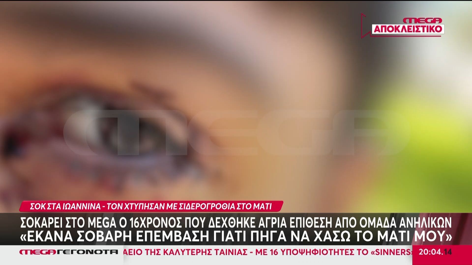 Σοκάρει στο Mega ο 16χρονος που δέχθηκε επίθεση από ανήλικους: «Έκανα επέμβαση γιατί πήγα να χάσω το μάτι μου»