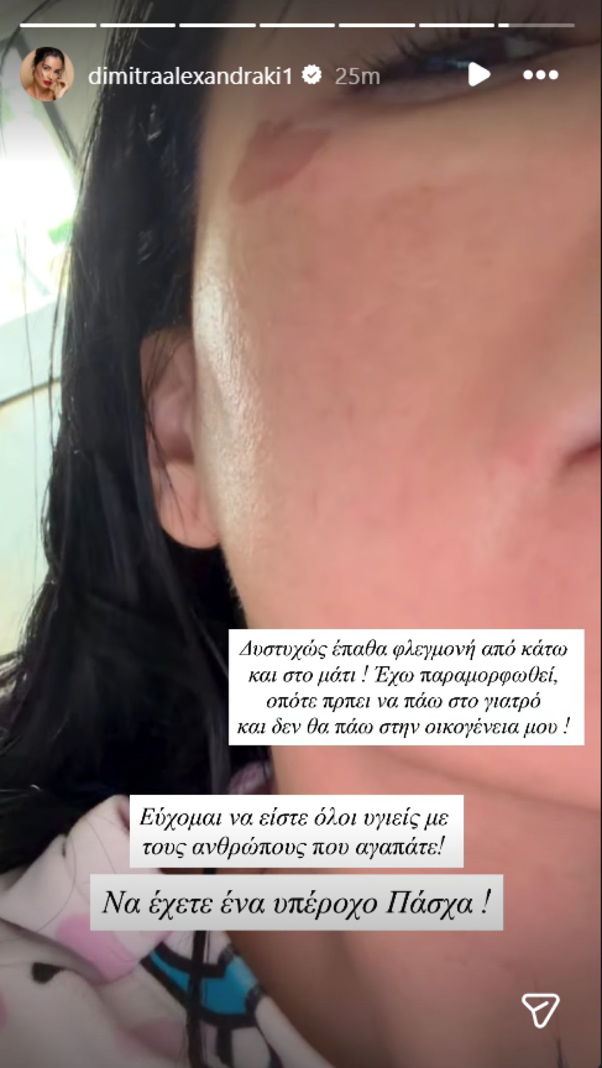 Δήμητρα Αλεξανδράκη: Υγειονομική περιπέτεια την ημέρα της Ανάστασης – «Έχω παραμορφωθεί» 2 Το story που έκανε η Δήμητρα Αλεξανδράκη