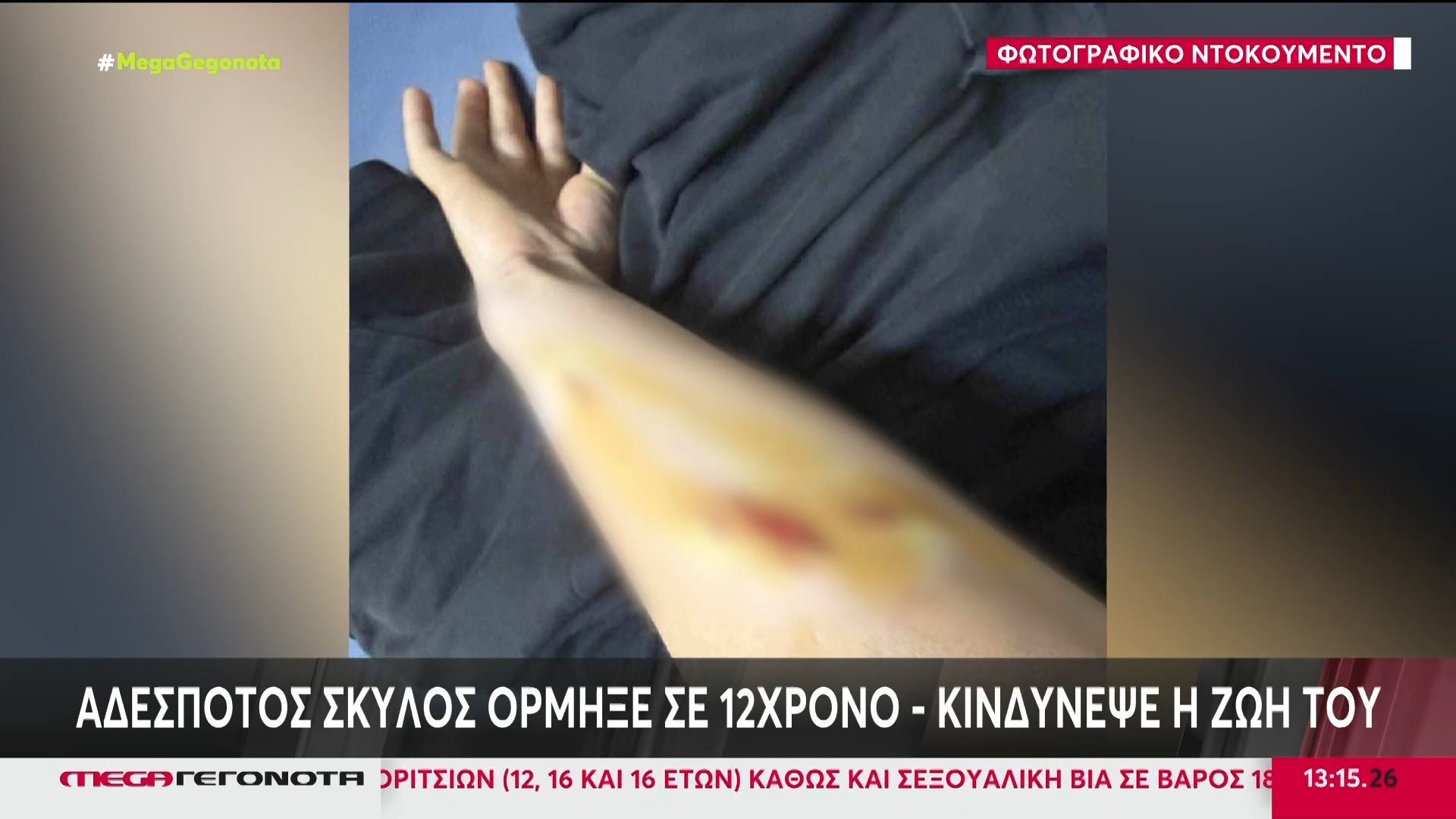 Φωτογραφικό ντοκουμέντο: Αδέσποτος σκύλος όρμηξε σε 12χρονο – Κινδύνεψε η ζωή του