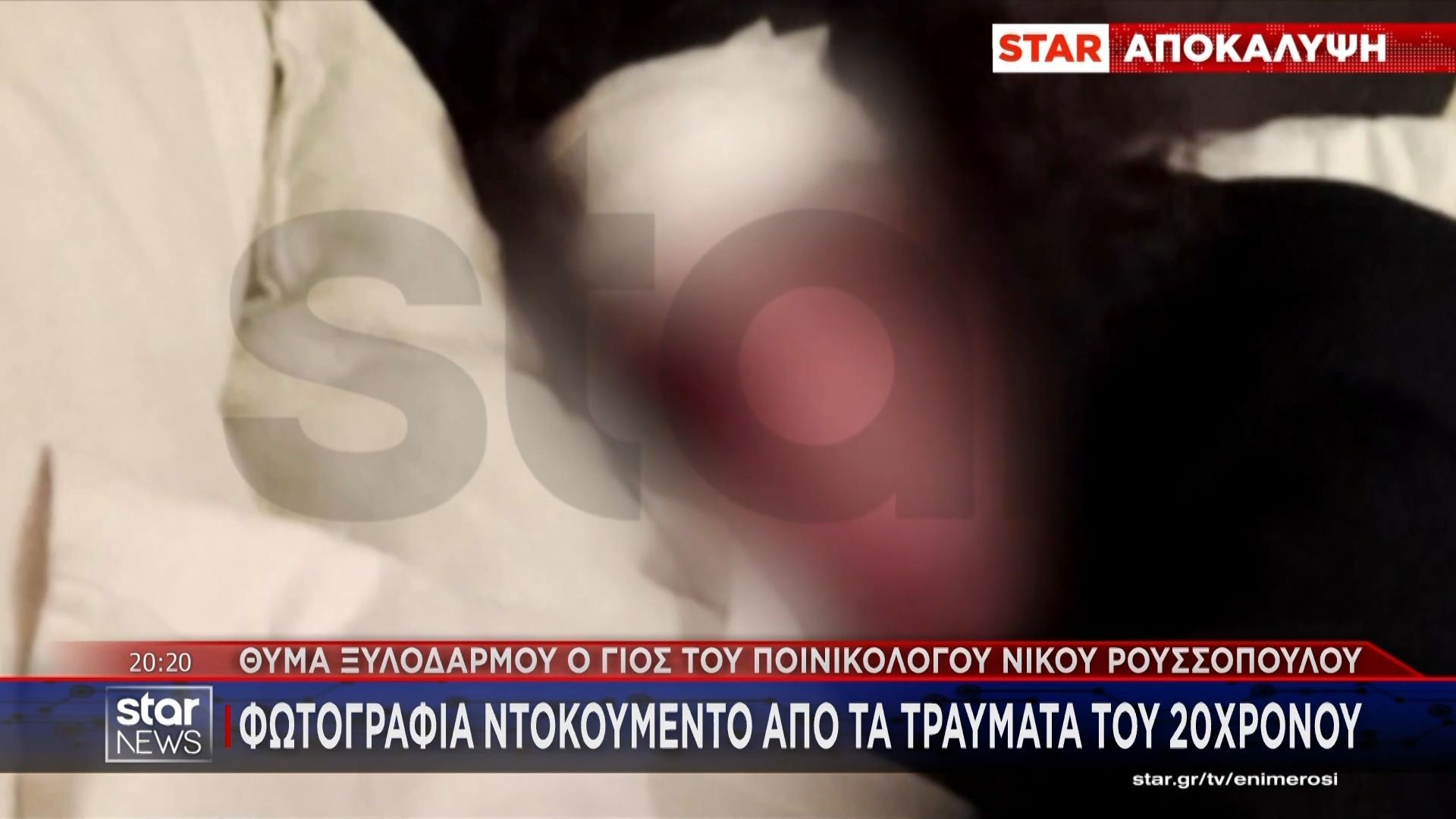 Θύμα ξυλοδαρμού ο γιος του ποινικολόγου, Νίκου Ρουσσόπουλου – Φωτογραφία ντοκουμέντο από τα τραύματα του 20χρονου