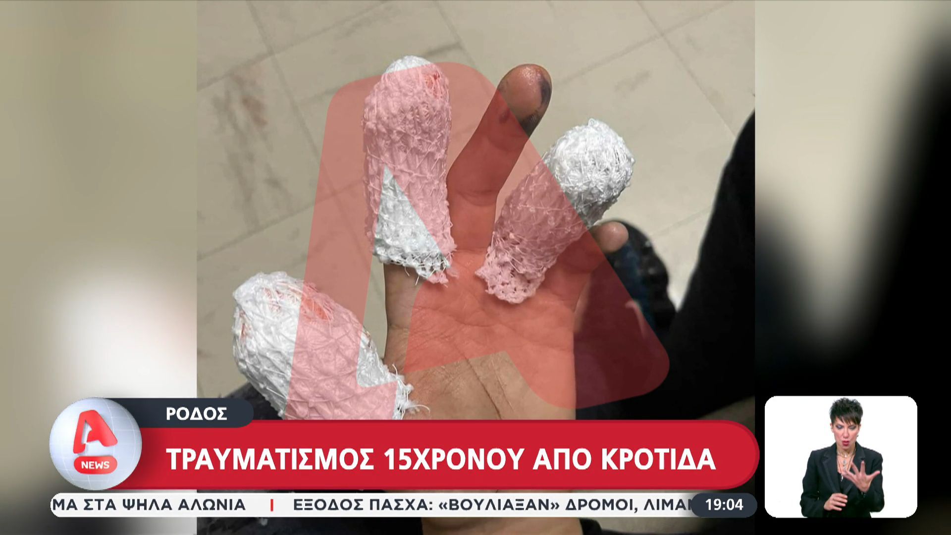 Τραυματισμός 15χρονου από κροτίδα στην Ρόδο