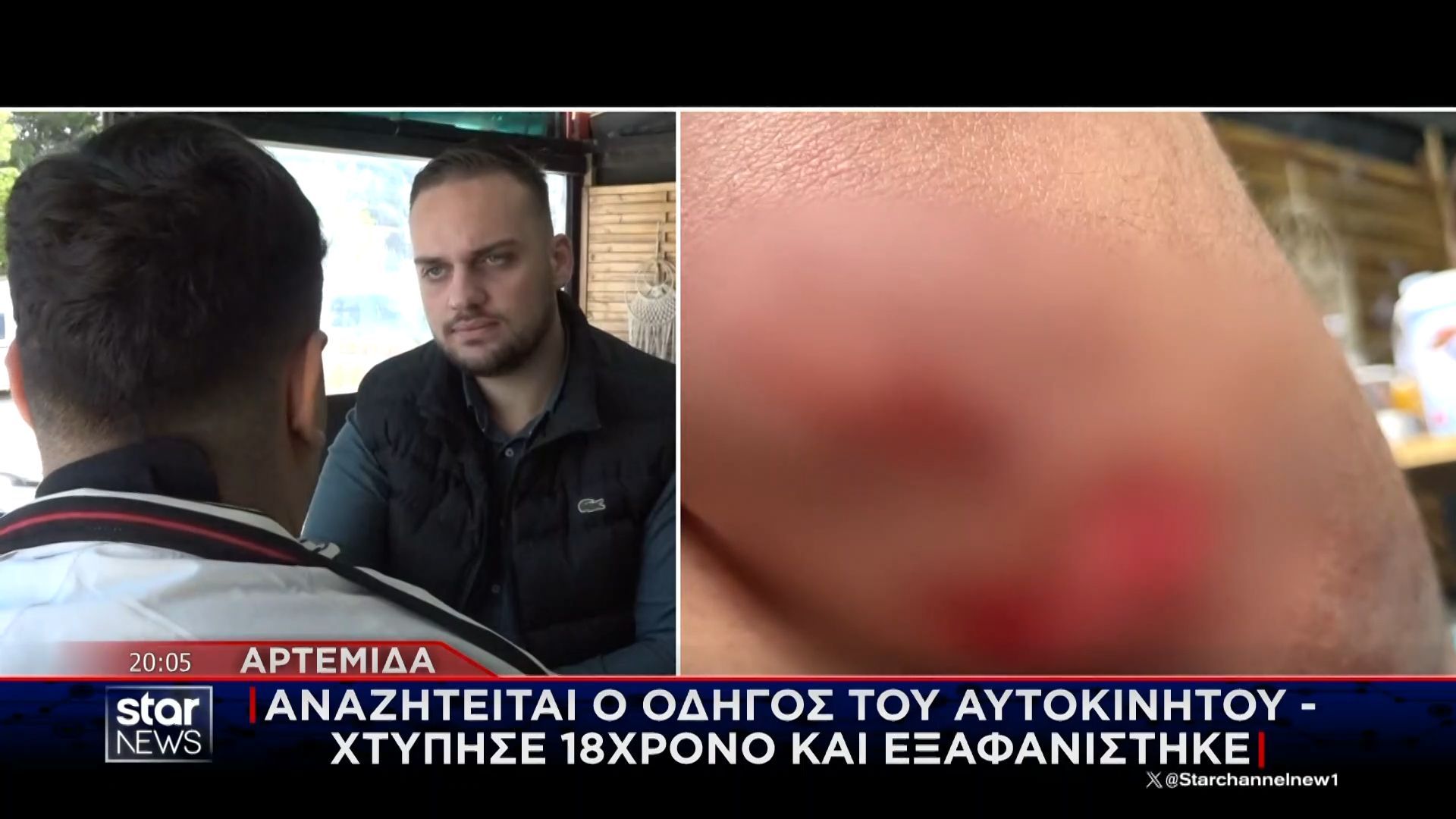 Τροχαίο με εγκατάλειψη στην Αρτέμιδα: Συγκλονίζει ο 18χρονος τραυματίας στο STAR