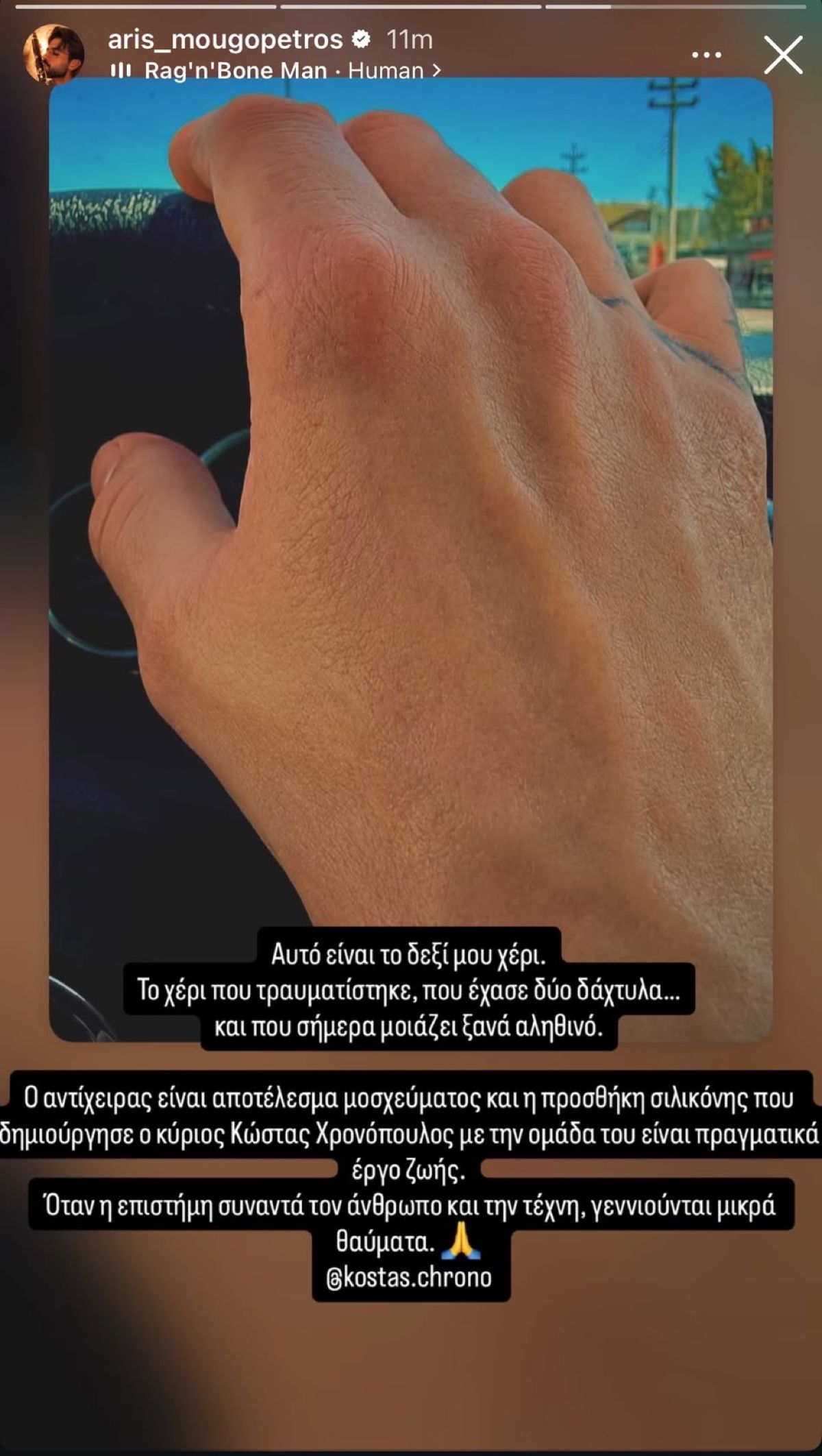 Ο Άρης Μουγκοπέτρος δείχνει το χέρι του