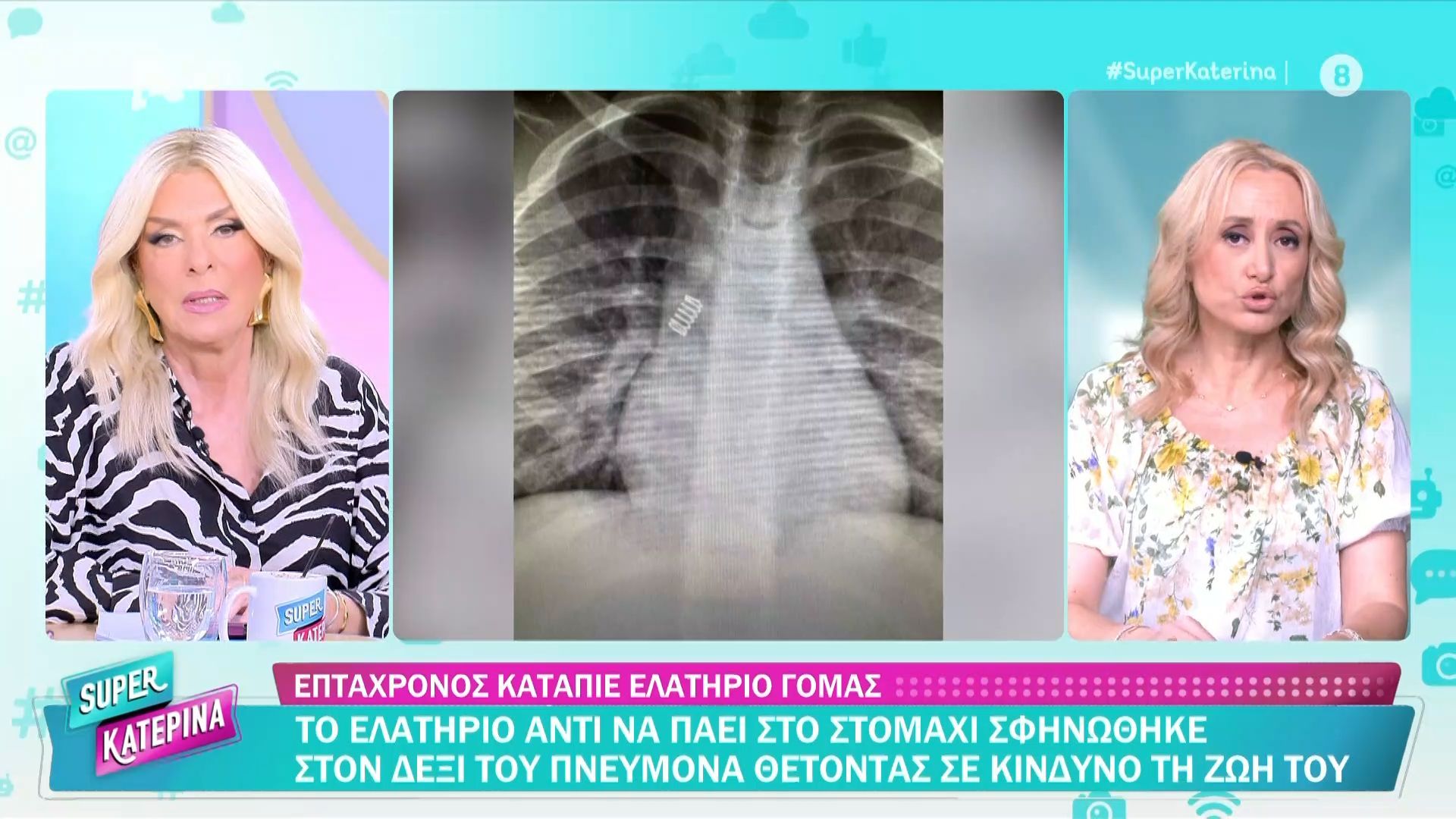 Επτάχρονος κατάπιε ελατήριο γόμας – Αντί να πάει στο στομάχι, σφηνώθηκε στον πνεύμονα