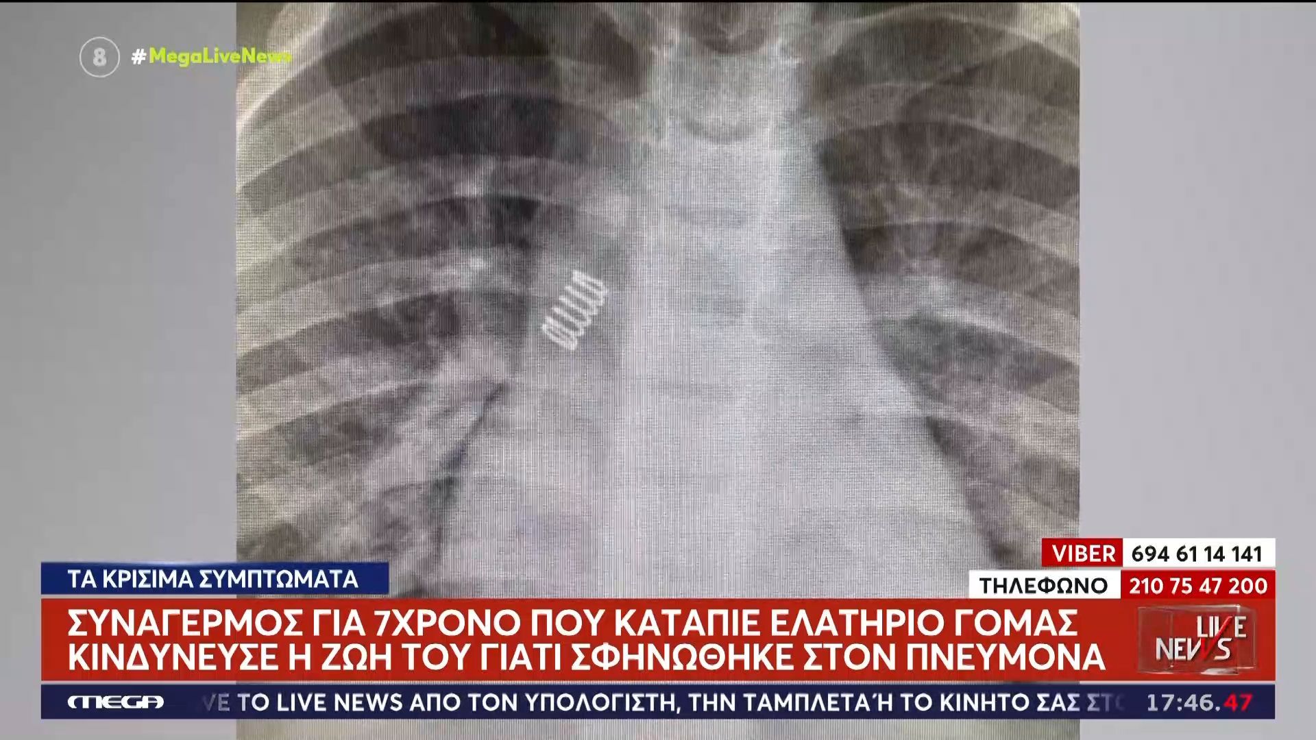 Συναγερμός για 7χρονο που κατάπιε ελατήριο γόμας