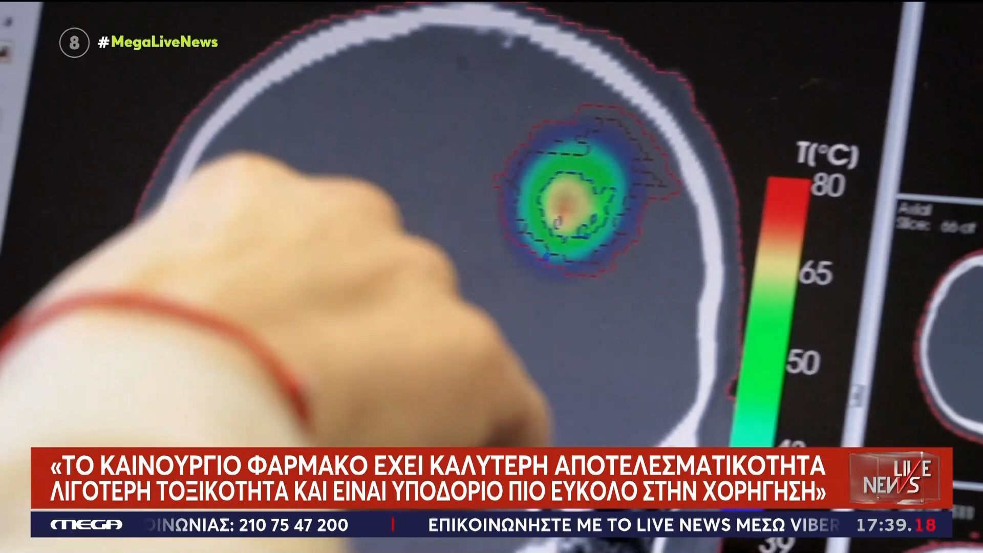 Νέα θεραπεία κατά του καρκίνου: Επαναστατικό φάρμακο εξαφανίζει τους όγκους