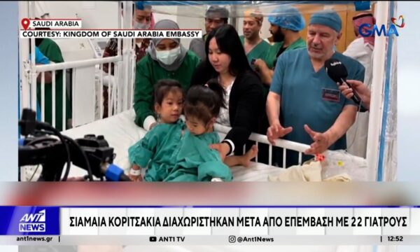 Σιαμαία κοριτσάκια χωρίστηκαν μετά από επέμβαση με 22 γιατρούς