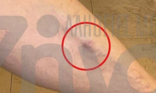 Θριάσιο: 38χρονος ασθενής καταγγέλλει ξυλοδαρμό από συνοδό άλλου ασθενούς μέσα στον θάλαμο νοσηλείας