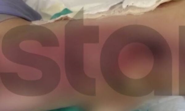 Θεσσαλονίκη: 20χρονη καταγγέλλει εγκαύματα γ’ βαθμού μετά από επέμβαση ρουτίνας – «Είχα γαντζωθεί στο κρεβάτι, έβραζαν τα πόδια μου»