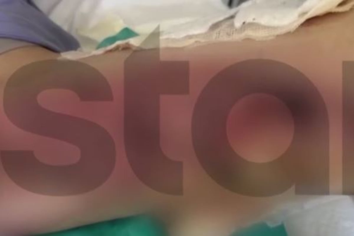 Θεσσαλονίκη: 20χρονη καταγγέλλει εγκαύματα γ’ βαθμού μετά από επέμβαση ρουτίνας – «Είχα γαντζωθεί στο κρεβάτι, έβραζαν τα πόδια μου»