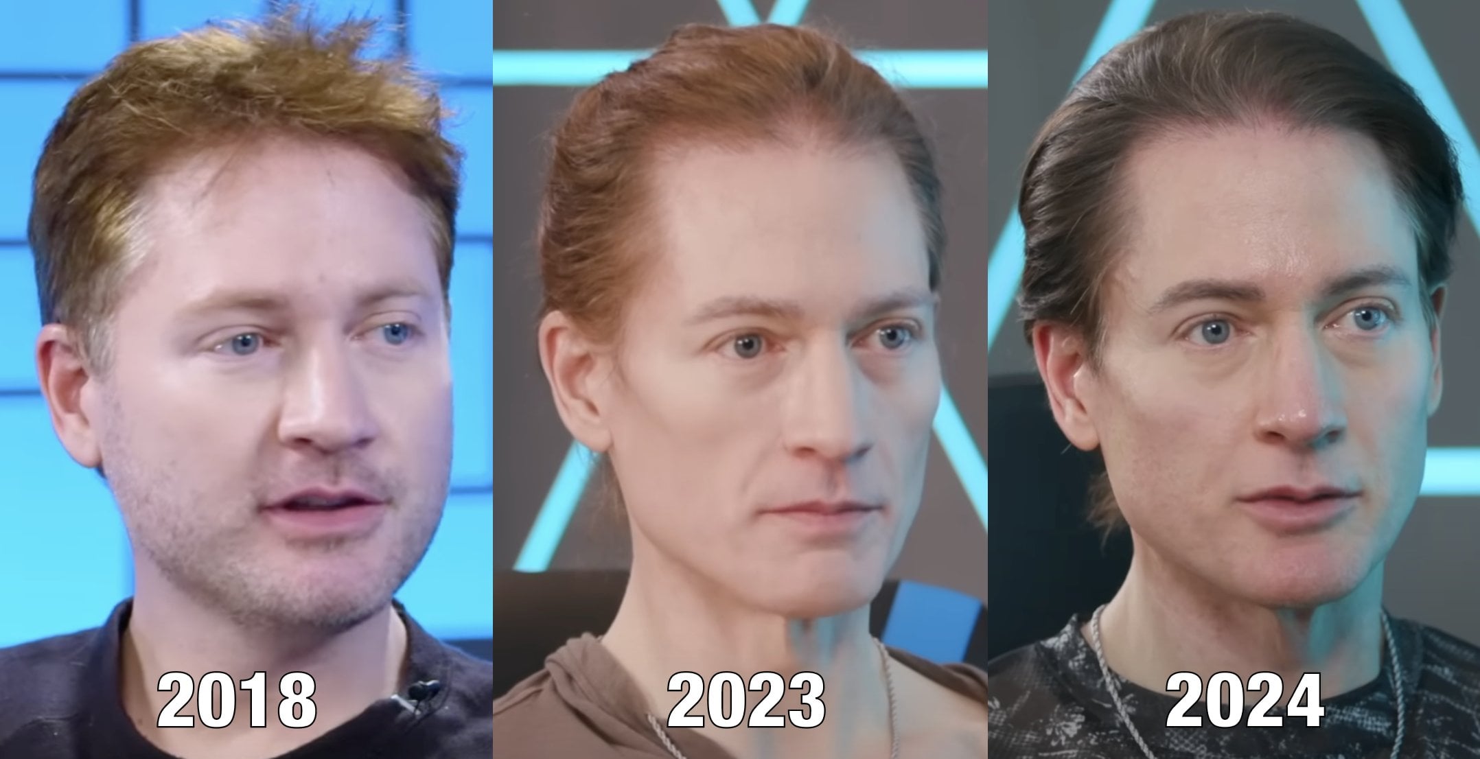 Bryan Johnson: Διαγνώστηκε με αυτοάνοσο ο biohacker που θέλει να ζήσει για πάντα – Τι είναι η ασθένεια που «τρώει το στομάχι»