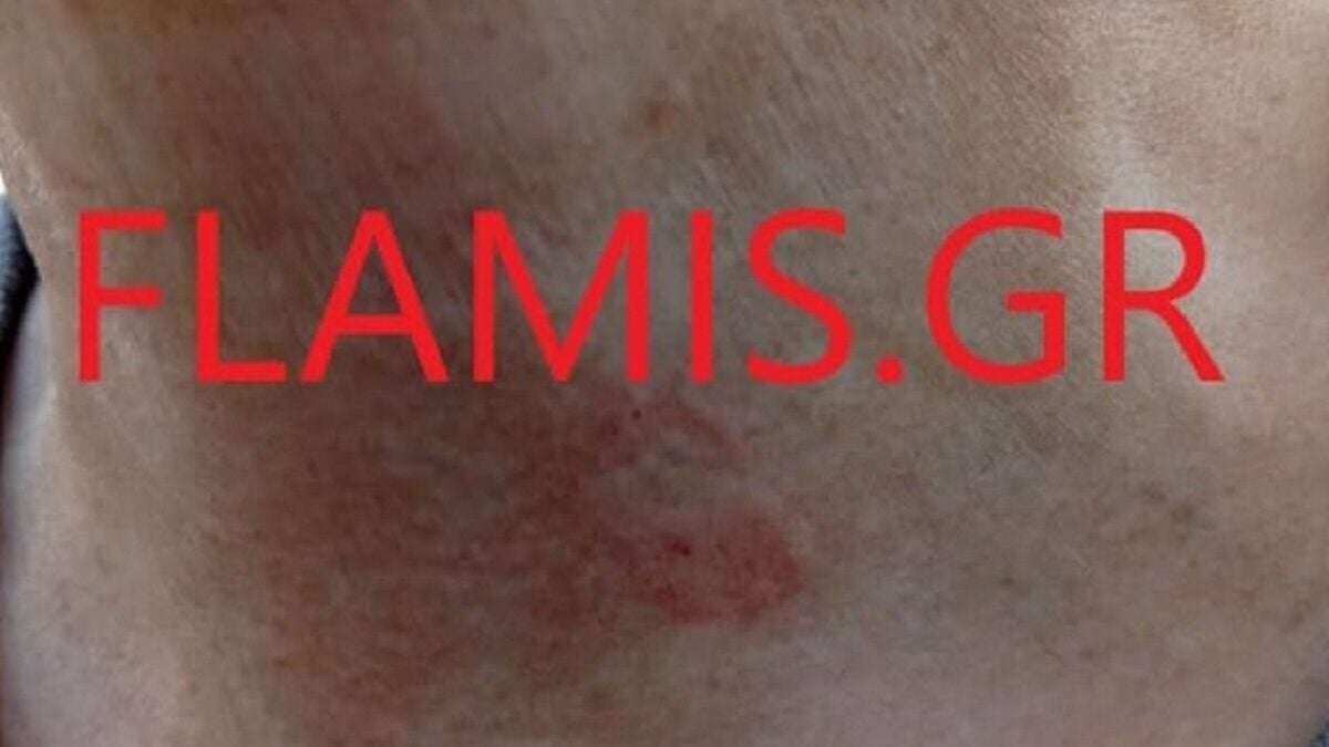 Πάτρα: Λαγοκέφαλος δάγκωσε γυναίκα κοντά στην καρωτίδα 1 Πάτρα: Λαγοκέφαλος δάγκωσε γυναίκα κοντά στην καρωτίδα
