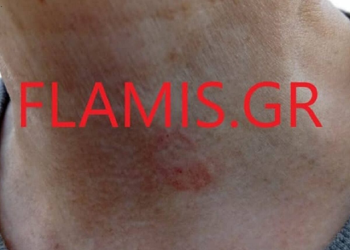 Πάτρα: Λαγοκέφαλος δάγκωσε γυναίκα κοντά στην καρωτίδα