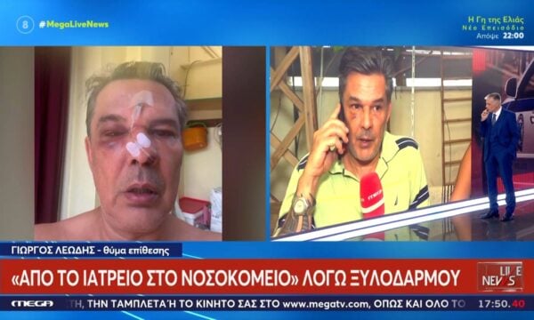 Χαϊδάρι: «Μου ‘χει σπάσει το κόκκαλο στη μύτη» – Τι λέει ο άνδρας που έπεσε θύμα ξυλοδαρμού μέσα σε ιατρείο