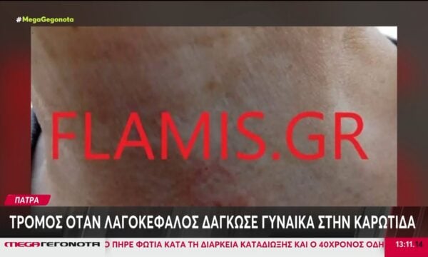 Πάτρα: Τρόμος όταν λαγοκέφαλος δάγκωσε γυναίκα στην καρωτίδα