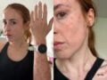 Influencer ξύπνησε σε ξενοδοχείο με σημάδια από τσιμπήματα κοριών σε όλο της το σώμα: «Έπαθα κρίση πανικού»