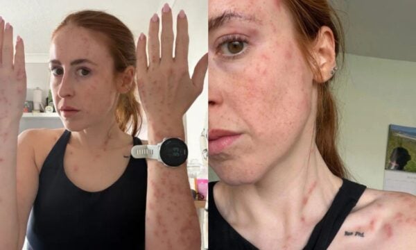 Influencer ξύπνησε σε ξενοδοχείο με σημάδια από τσιμπήματα κοριών σε όλο της το σώμα: «Έπαθα κρίση πανικού»