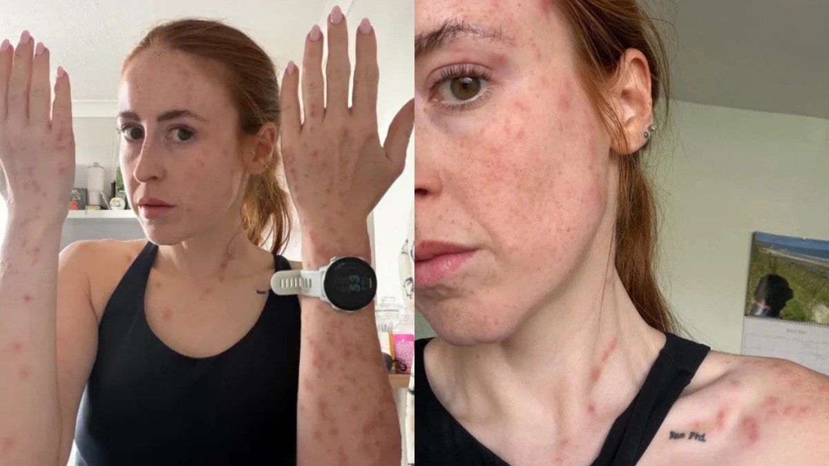 Influencer ξύπνησε σε ξενοδοχείο με σημάδια από τσιμπήματα κοριών σε όλο της το σώμα: «Έπαθα κρίση πανικού»