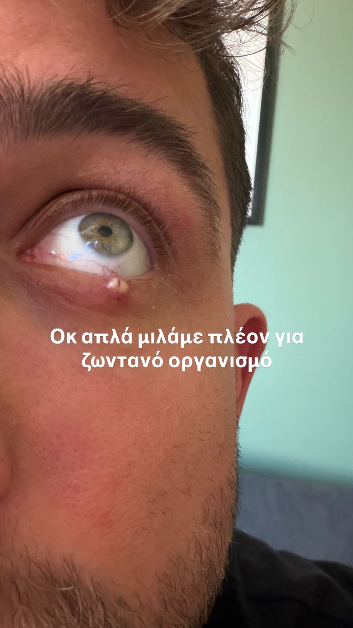 Fipster: Τι είναι το χαλάζιο στο μάτι του, από τι προκαλείται και πώς αντιμετωπίζεται 9 Fipster χαλάζιο