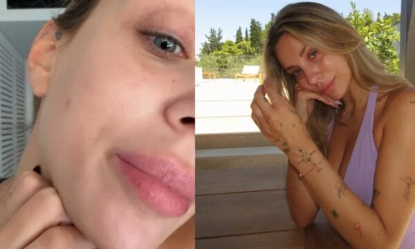Γαρυφαλλιά Καληφώνη: Η πάθηση που την ταλαιπωρεί – «Αν έρθω μπροστά στην κάμερα θα τρομάξετε…»
